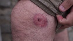 Povrijeđeni novinar tvrdi da je gruzijska policija koristila gumene metke protiv demonstranata